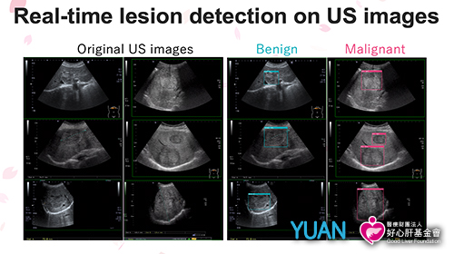 Taiwan's Invention of An AI Real-Time Detection and Diagnosis of Liver Tumor with Ultrasound Won the Award